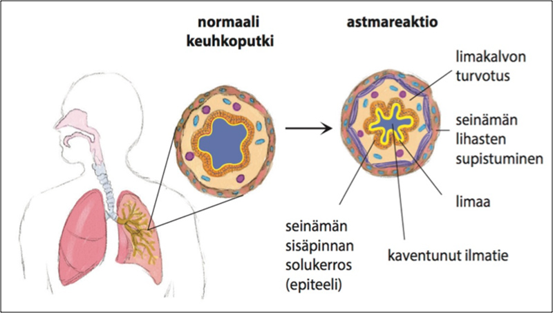 keuhkoputket_astma